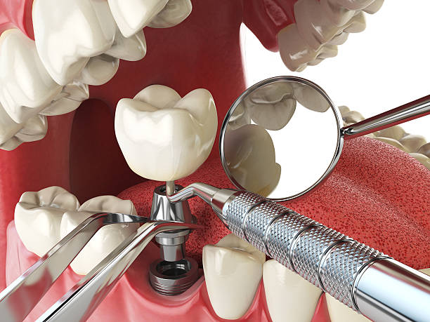 Best Emergency Dentist for Knocked-Out Tooth in Austell, GA